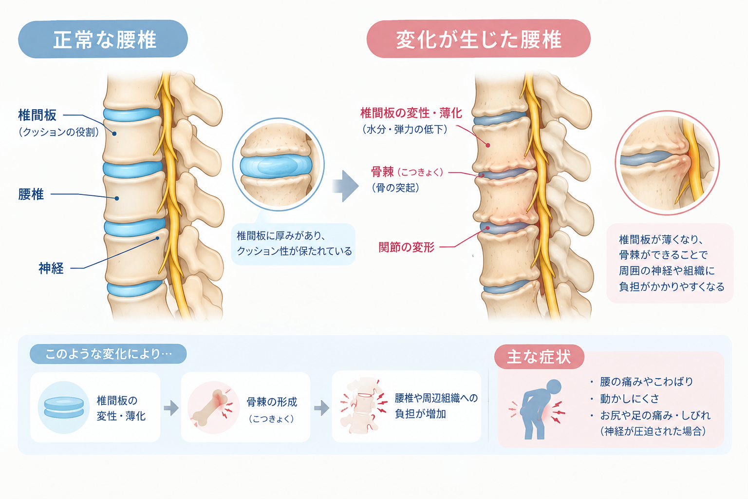 変形性腰椎症による腰椎の変化と正常な腰椎の比較
