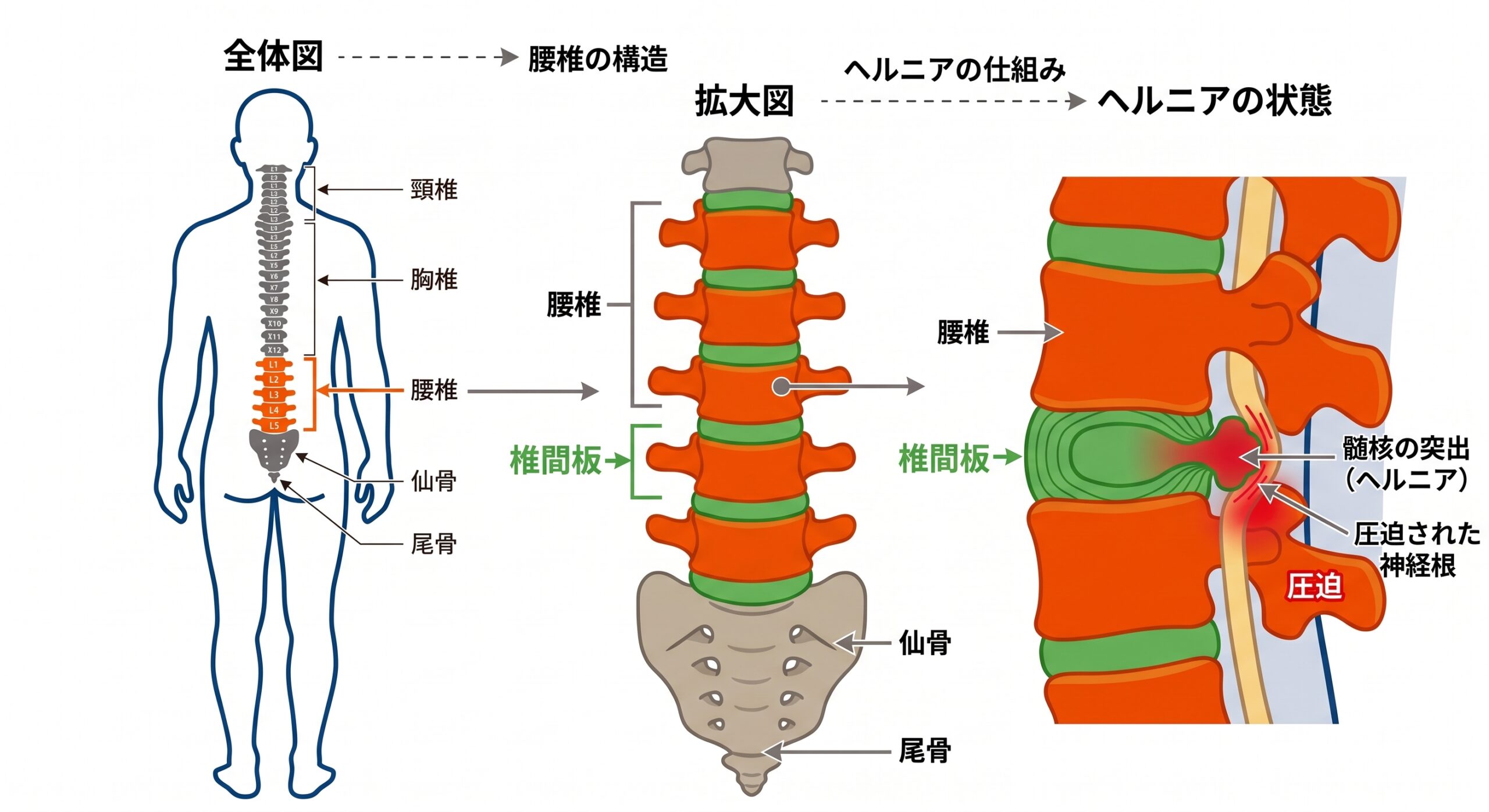腰椎椎間板ヘルニアのイメージ画像