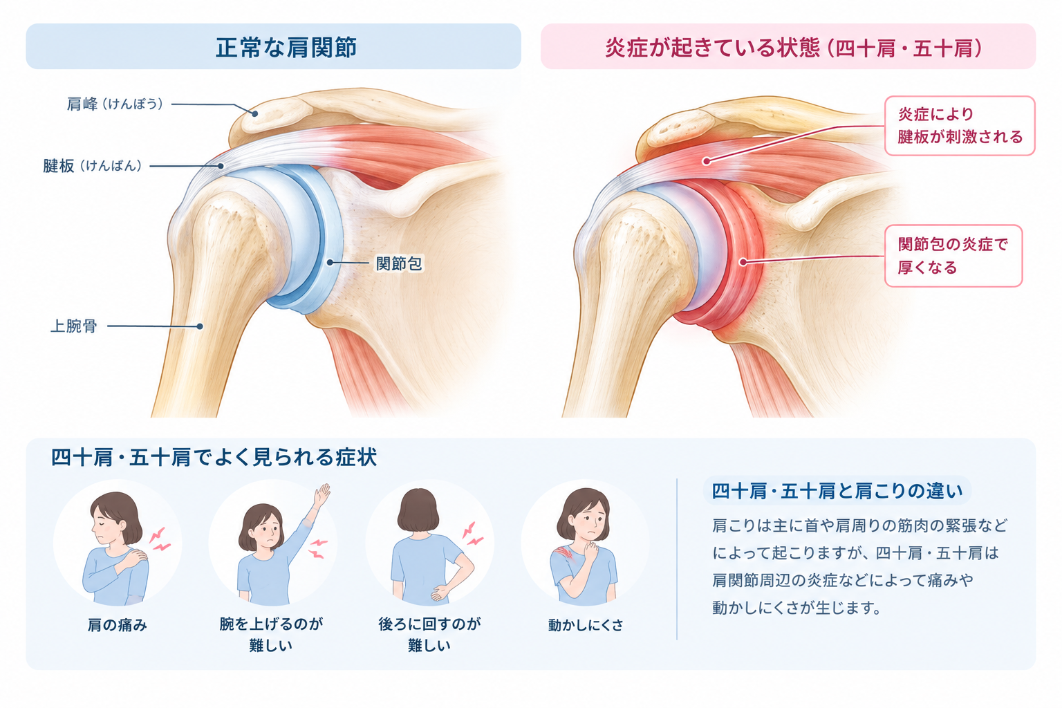 正常な肩関節と炎症が起きている状態の比較
